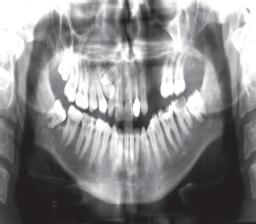 without any complication to the adjacent teeth.