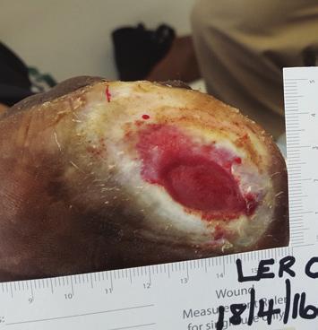 The abscess was drained and negative-pressure wound therapy