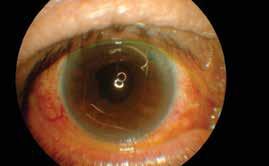 The patient was admitted to the eye ward for stabilisation of the IOP medically and planned for intracapsular cataract extraction (ICCE) and anterior chamber IOL under LA.