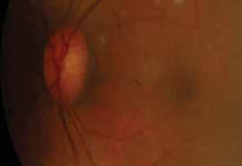 There was no eye discharge, recent trauma or contact with people with conjunctivitis. He had a history of blunt force trauma to the right eye 10 years ago and was treated conservatively.