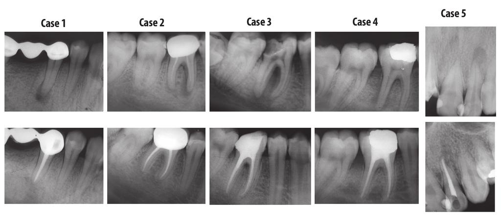 Single and multiple-visit root canal treatment Radiographic Assessments and Follow-up The pre/postoperative periapical radiographs were taken using an x-ray machine (Prostyle- Intra, Planmeca,
