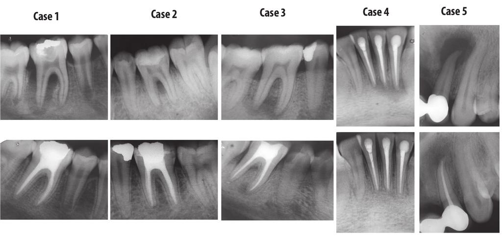 All radiographs were evaluated two years postoperatively under optimal conditions where the surrounding light could be controlled for the best possible radiographic contrast (Figures 1 and 2).