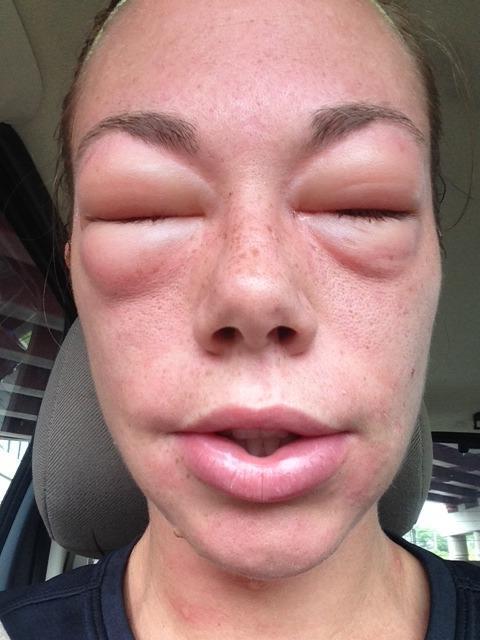Allergic Reaction Face