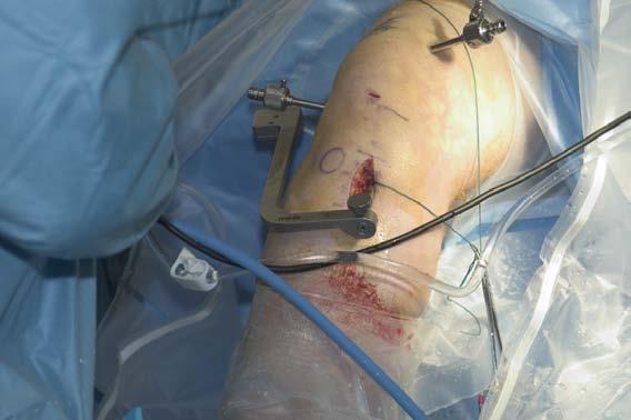 through the knee. Prior to inserting the graft, I mark my graft on the femoral side 30mm from the tip, thus allowing me to determine full insertion into the femoral tunnel (Fig. 21).