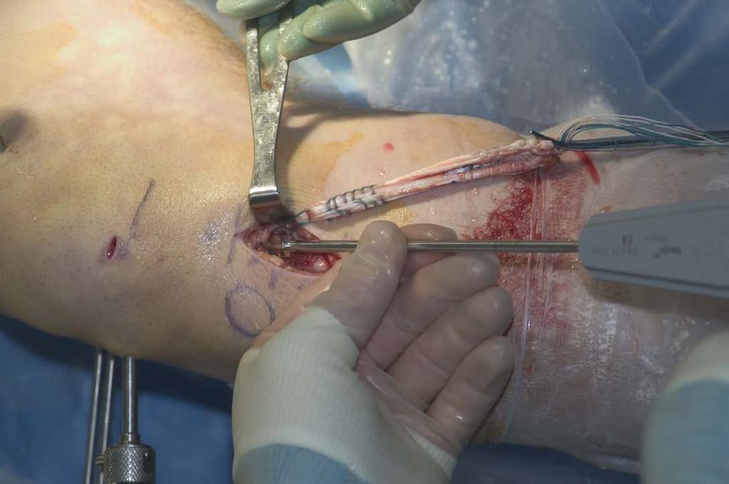 Using the DePuy Mitek RIGIDFIX Soft Tissue System, I begin by selecting a cannulated femoral rod that corresponds with the size of my femoral tunnel (i.e., a 9mm RIGIDFIX femoral rod for a 9mm femoral tunnel) and attach it to the RIGIDFIX guide frame (Fig.