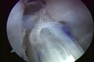 Note that the extra-articular portion of the RIGIDFIX guide frame lies on the lateral side of the operative knee.
