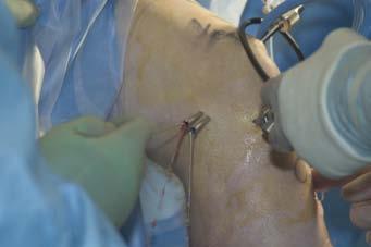 This may be accomplished by removing the guide pin entirely from the knee or simply sliding it down from the femoral location.
