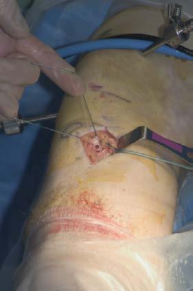 Tibial Fixation (Fig.