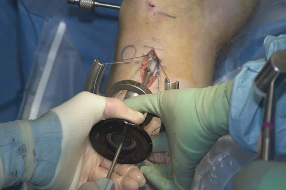 This same step is used for other soft tissue grafts as well, such as an anterior tibialis allograft. I first measure the one set of sutures to a distance of 5 from the exit from the tibia.