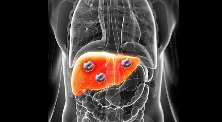 Treatments options in patients with liver dysfunction ~ 50% of patients with CRC will develop liver metastases during their lifetime - 20% synchronous - 30% metachronous Mechanism of liver