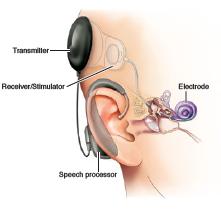 How does a cochlear implant work?