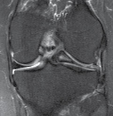 H R J Post-injury painful and locked knee, p. 54-59 Clinical Case - Test Yourself Musculoskeletal Imaging Post-injury painful and locked knee Ioannis I. Daskalakis 1, 2, Apostolos H.