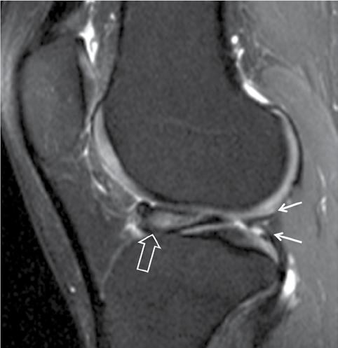 thickened with a resulting greater coverage of the tibial articular surface. As a result, asymmetric loading forces are applied onto the knee joint, leading to meniscal degeneration and tears.