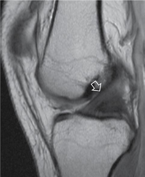 Post-injury painful and locked knee, p. 54-59 HR J Fig. 3.