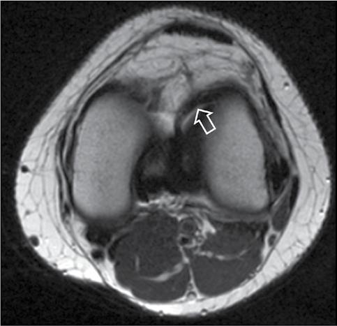 Sagittal PD-W MR image showing the "anterior flip" sign consisting of the large and displaced