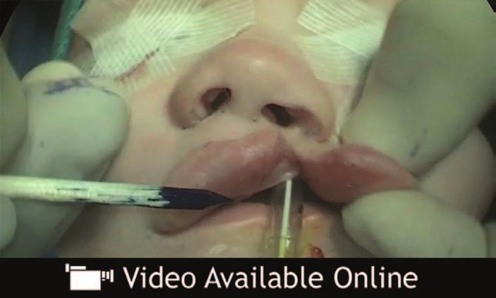 alveolus, and Veau III palate, treated by the Fisher technique. Video 1.