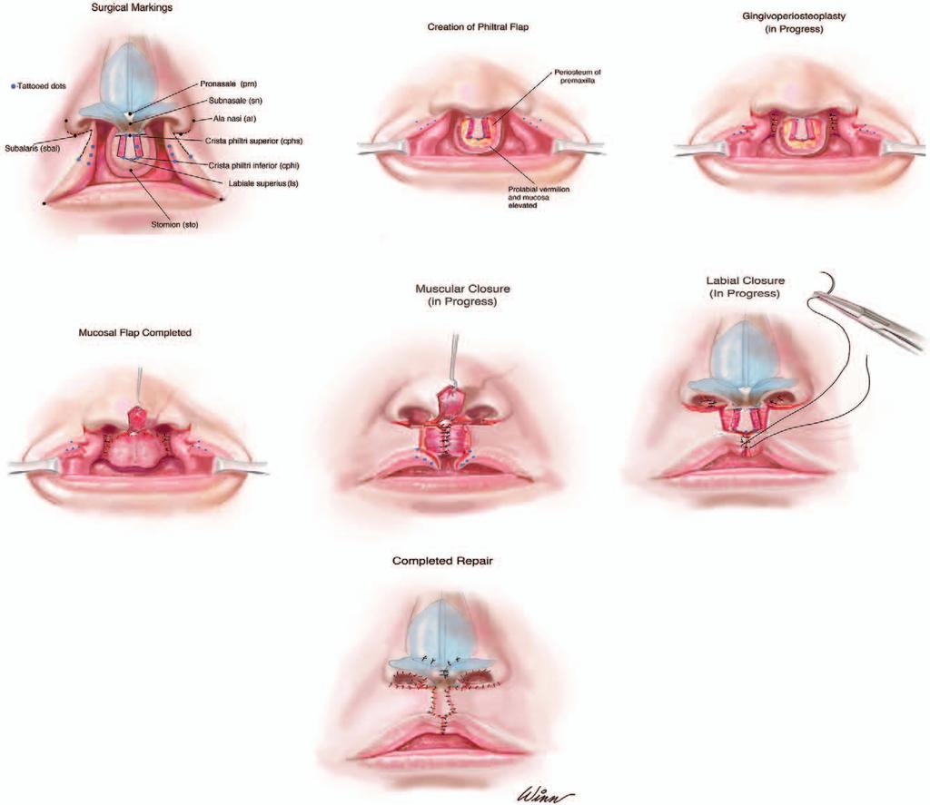Plastic and Reconstructive Surgery March 2017 Fig. 14. Repair of bilateral complete cleft lip, as described by Mulliken.