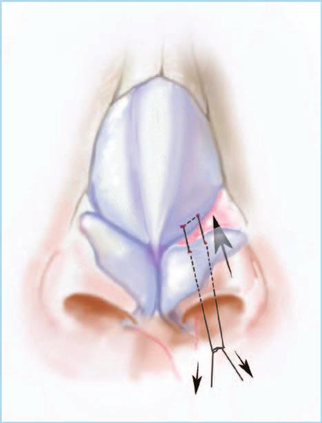 Plastic and Reconstructive Surgery March 2017 Semiopen Approach In the semiopen approach, 16 bilateral alar rim incisions are made just within the vestibule, with care taken to respect the skin of