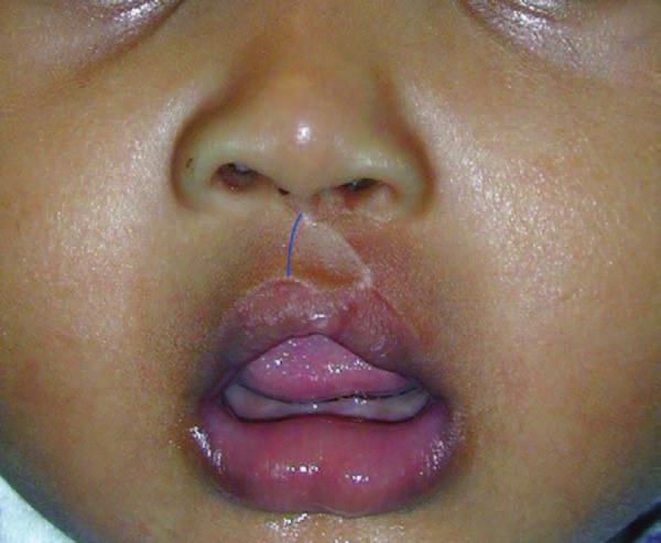 Volume 139, Number 3 Principalization of Cleft Lip Repair triangular flap. The height of the dry vermilion on the medial labial element is invariably less than that on the lateral labial element.