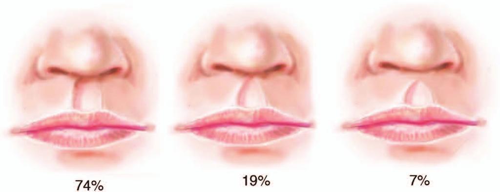 Noordhoff described a technique to avoid this problem in which this excess vermilion on the lateral labial element is used to form a triangular flap that is inset at or just above the red line (Fig.