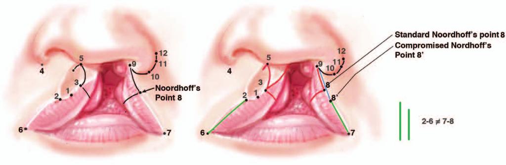 Definitive cheiloplasty should be deferred until 3 to 4 months after successful setback. Fig. 7.