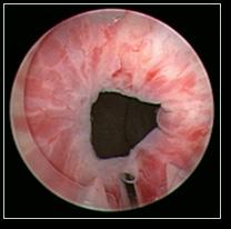 Bulkamid procedure Emptying of the bladder (if required) Dilation of the urethra The Bulkamid rotatable sheath is Ch. 22 (7-8 Hegar dilator).