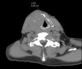 Figure 3: CT scan showing a 52-mm soft tissue density mass in the right thyroid lobe with thyroid cartilage destruction. No pathologic adenopathy is evidenced.