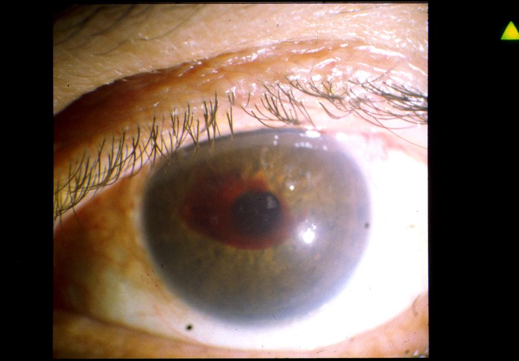 490 Glaucoma - Basic and Clinical Aspects Figure 5. Hemorrhagic Descemet's membrane detachment 3 weeks postoperatively (arrow).