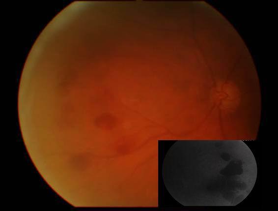 Combined Cataract-Glaucoma Surgery http://dx.doi.org/10.5772/54808 491 Figure 6. Decompression retinopathy. Insert: red free picture. This patient had a decrease of his visual acuity from 0.