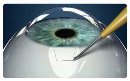 EX-PRESS Glaucoma Filtration Device Step by Step Create 40-50%