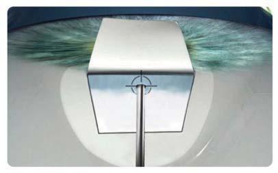 EX-PRESS Glaucoma Filtration Device Step by Step Create