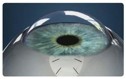 EX-PRESS Glaucoma Filtration Device Step