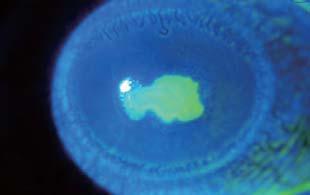 Case#2 Post-DSAEK After DSAEK, since post-op corneal astigmatism is less likely to occur, a
