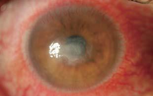 Corneal irregular astigmatism is seen more in the posterior surface than in the anterior,