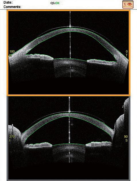 The upper row images show changes during HCL wearing, the center row shows changes after removing the HCL, and the bottom row images show the Power changes.