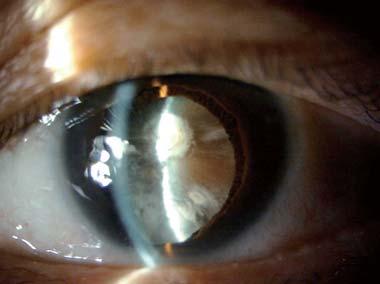 It had a huge impact on visualizing not only the clear cornea but also opaque tissue