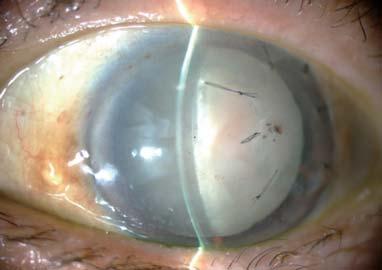 7 years later, the CASIA2 has emerged as the next-generation Anterior Segment OCT.