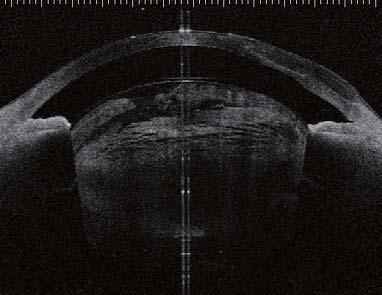 measurement range of depth to 13mm, which has made it possible to visualize the anterior
