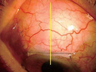 Case#3 EX-PRESS Glaucoma Shunt Surgery (Post-op 4M) Case#4