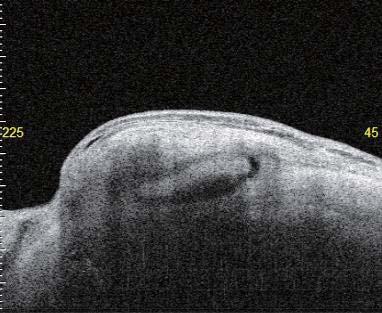 the sub-scleral flap and the ciliary body can be observed.