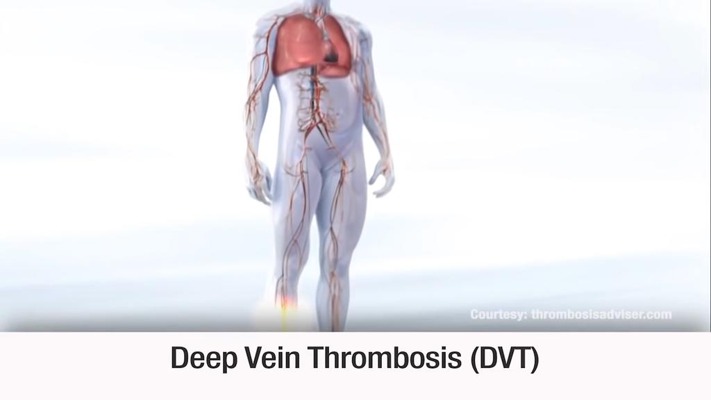 Blood clots in the thigh are more likely to break off and travel to the lungs than blood clots