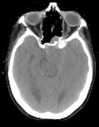 Brain Example Registered CT Original MR