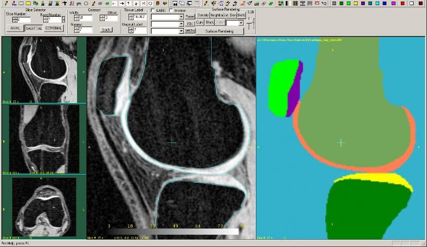 Semi-automated (radiologist corrected) morphological segmentation