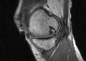 adjacent cartilage >50% 3: complete filling VAS for Pain (mean +/- SE) 60 50 40 30 20 10 0 Baseline 1 month 3 months 6 months MRI illustrates performance of