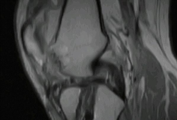 primary repair (2 implants) Summary 2D MRI T2 mapping