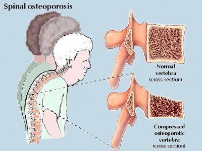 Most people find they have Osteoporosis after they have fallen and