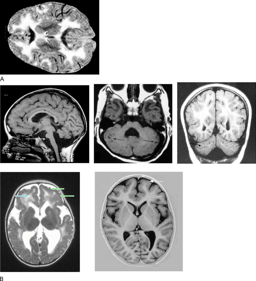 F. Muntoni, T. Voit / Neuromuscular Disorders 14 (2004) 635 649 639 Fig. 2. (A) Typical white matter changes observed in MDC1A. The corpus callosum and the cerebellum are spared.