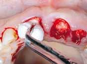 The healing of an extraction socket following tooth removal is characterized by the formation and maturation of a blood clot, followed by infiltration of fibroblasts to replace the