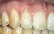 Augmentation of attached gingiva;
