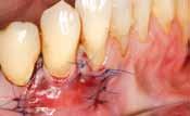 with attached pink, keratinized gingival